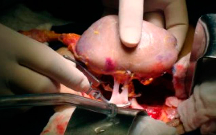 Trasplante renal. Trasplante renal.