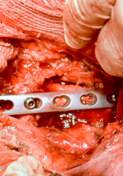 Láminas colocadas tras lumbotomía compleja por vía anterior. Láminas colocadas tras lumbotomía compleja por vía anterior.