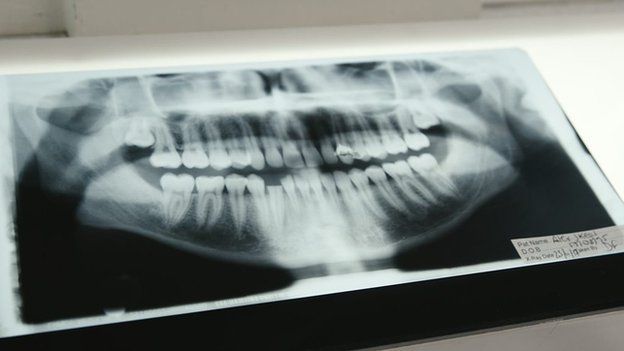 Radiografí­a de los dientes