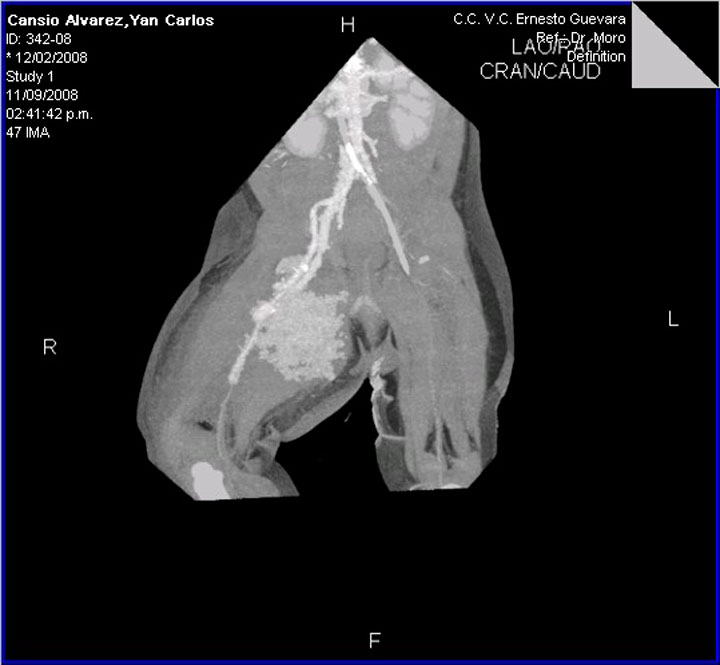 Imagen de la fístula arteriovenosa.
