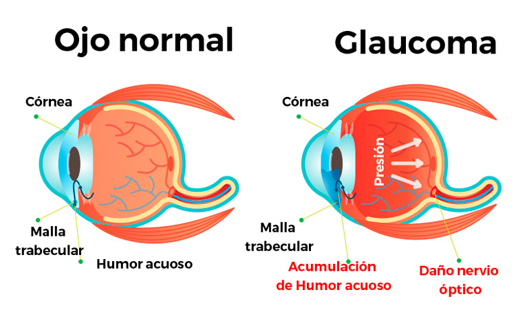 Imagen sobre los efectos de la glaucoma.
