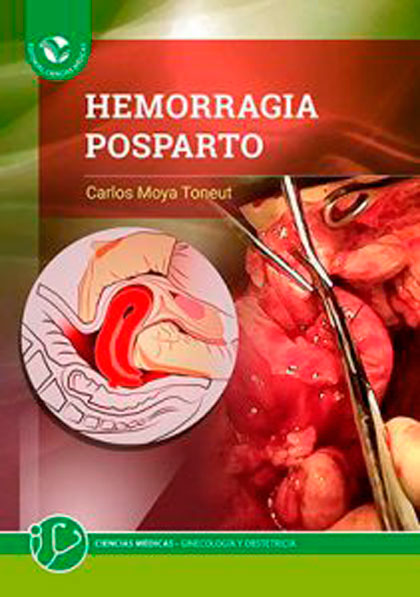 Libro Hermorragia postparto, del Dr. Carlos Moya Toneut. Libro Hermorragia postparto, del Dr. Carlos Moya Toneut.