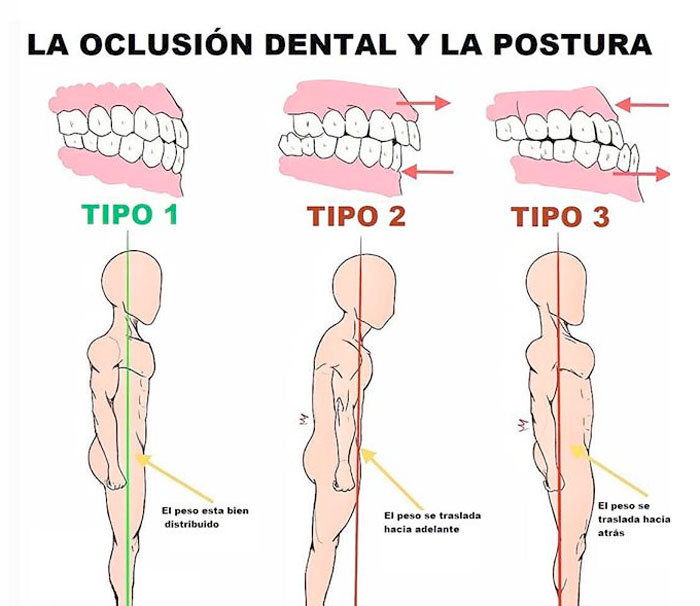 Relación entre las maloclusiones y la postura.