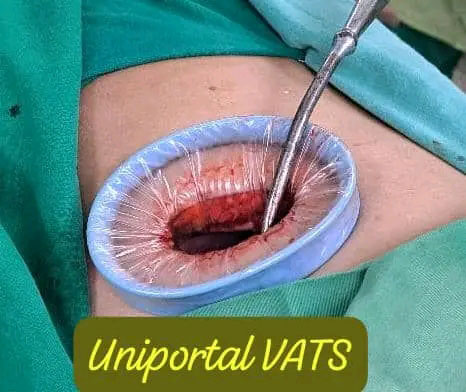 Uniportal VATS.